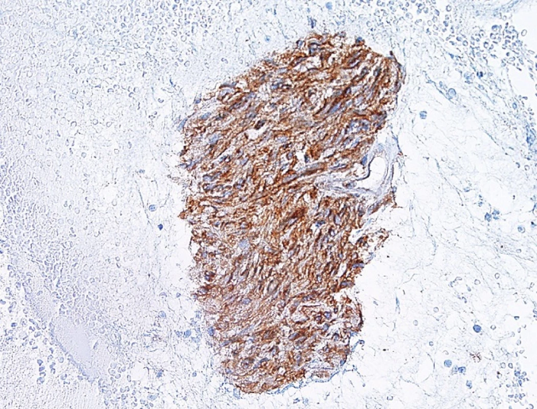 GIST – imunocytochemický průkaz CD117.