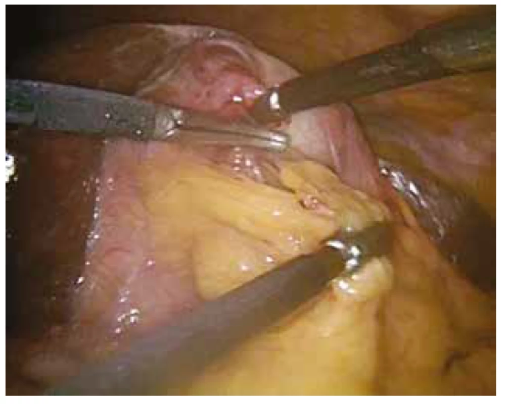 Hydropický žlučník se subakutními zánětlivými
změnami při situs viscerum inversus<br>
Fig. 2: Gallbladder hydrops with subacute inflammation
in situs viscerum inversus