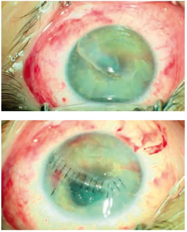 Perforující poranění rohovky ošetřené suturou. Perforating corneal injury treated with sutures.
