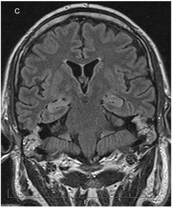 Padesátičtyřletý pacient přijat po epileptickém záchvatu, jemuž předcházela únava, bolesti horních končetin a kůže na hrudi. V likvoru obraz serózního zánětu, dle sérologického vyšetření nejspíše boreliového. Iniciální MRI mozku normální. Při kontrolních vyšetřeních moku regredují zánětlivé změny a stoupají destrukční markery. Klinicky hyperalgický syndrom na trupu, neklid a zmatenost. Na obrázku a je patrný rytmický iktální vzorec superponovaný na pomalou aktivitu nad pravou hemisférou. Na obrázku b jsou PEDs s maximem fronto-temporálně vpravo (šipky). Na kontrolním MRI mozku (c) lehce zvýšený signál obou AHK.