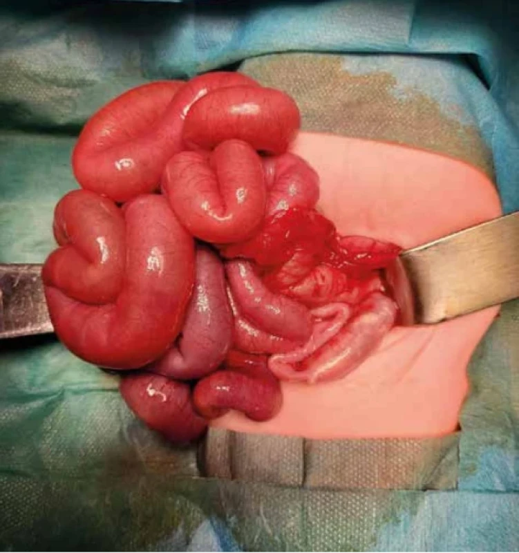 Perioperačný nález, dilatované kľučky tenkého čreva s kompletnou obturáciou (približne 10 cm pred ileocekálnou chlopňou)