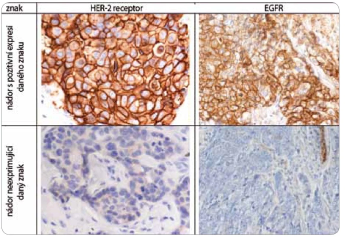 Imunohistochemické vyšetření sledovaných znaků v nádorové tkáni karcinomů prsu.