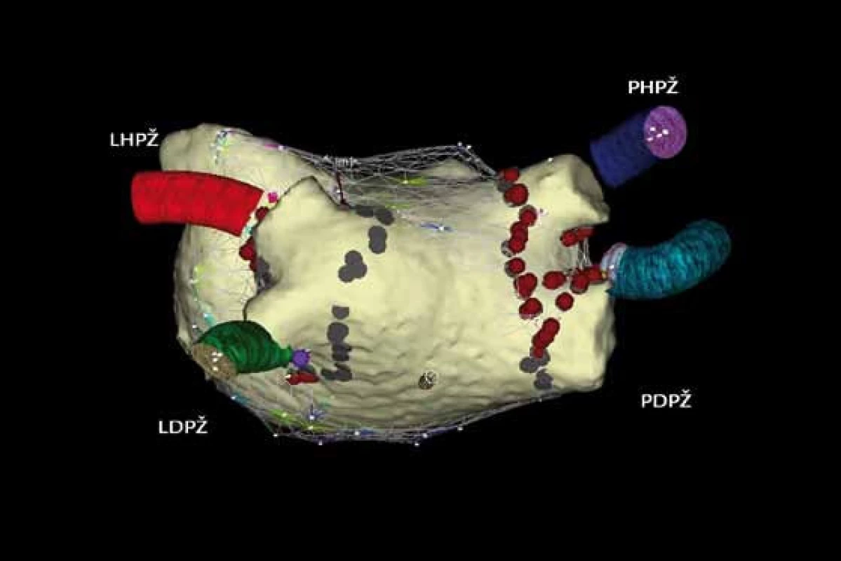 Integrace trojrozměrné elektroanatomické mapy systémem CARTO s rekonstrukcí levé síně a plicních žil pomocí počítačové tomografie. 
Cirkumferenční ablační linie kolem pravostranných a levostranných plicních žil u paroxyzmální formy FS.
Legenda k obr. 4, 5, 6 (pohled PA – posteroanteriorní na zadní stěnu levé síně). PHPŽ – pravá horní plicní žíla, PDPŽ – pravá dolní plicní žíla, LHPŽ – levá horní plicní žíla, LDPŽ – levá dolní plicní žíla
