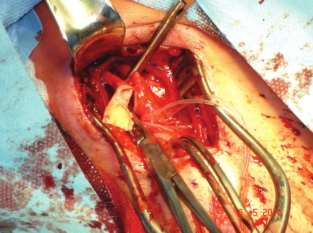 ACI po endarterektomii a parciální resekci
Fig. 2: ICA after endarterectomy and partial resection