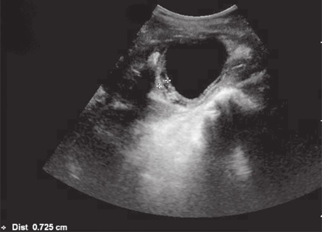 Ultrazvukový obraz dilatace stěny žlučníku na 7 mm
Fig. 2: Ultrasound image dilation of the gallbladder wall at 7 mm