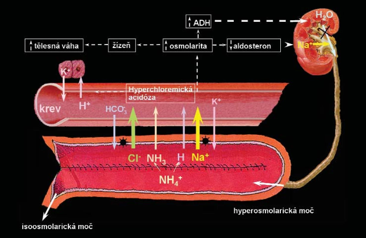 Navrhovaný mechanismus vzniku hyperchloremické acidózy u pacientů s ortotopickou neovezikou ze segmentu kolon. Sliznice kolon aktivně transportuje NaCl z moči do krevního řečiště – následováno pasivním transportem H<sub>2</sub>0 – následně vzniká hyperchloremická acidóza a retence tekutin. Ačkoliv tento mechanismus nebyl ještě zcela objasněn, acidóza je vyvolána také absorpcí chloridu amonného.
Otištěno se svolením.
ADH – antidiuretický hormon, H<sub>2</sub>0 – voda, Na<sup>+</sup>– sodík, H<sup>+</sup>– vodík, K<sup>+</sup>– draslík, Cl<sup>-</sup> – chlor, HCO<sub>3</sub><sup>-</sup> – hydrogenuhličitan sodný, NH3<sup>-</sup> amoniak, NH4<sup>+</sup>– amonium [34].