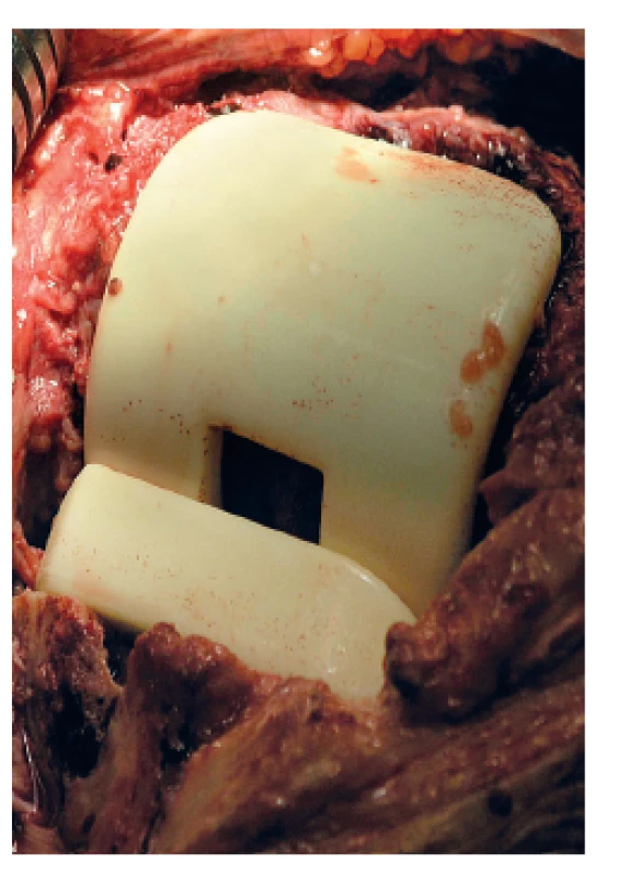 Peroperační snímek implantovaného kolenního spaceru Synicem<sup>®</sup>
Fig 2. Perioperative photo of an implanted Synicem<sup>®</sup> knee spacer