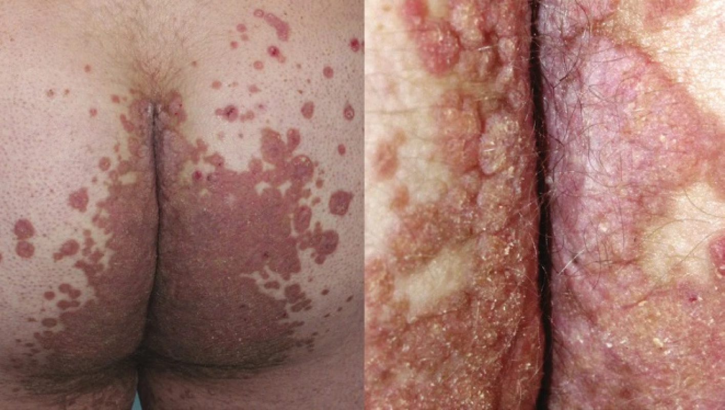 Porokeratosis ptychotropica