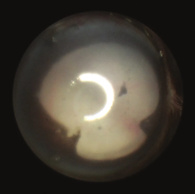 Zadní synechie na fotografii předního segmentu přítomné 25. den po indukci EAU