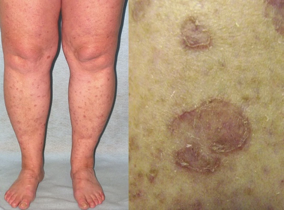 Porokeratosis superficialis actinica disseminata
