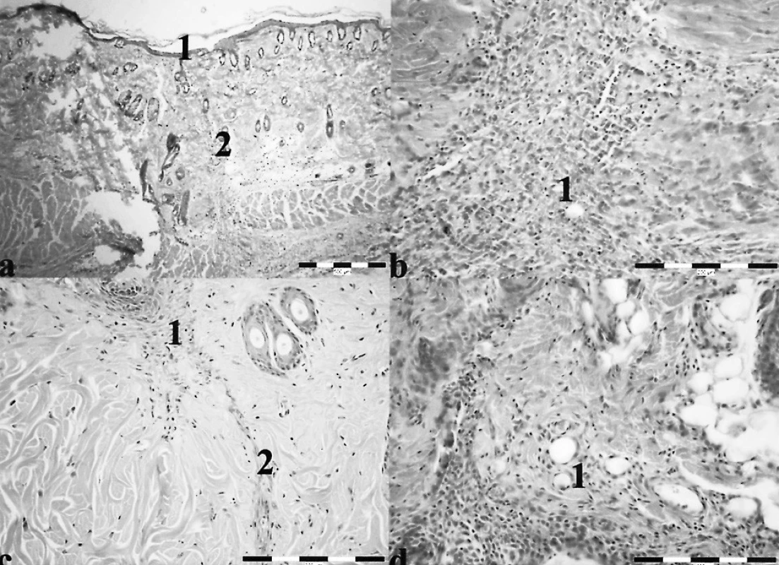 a. Kontrolná rana (zdravé potkany, HE, 100x), 1 – ukončenie procesu reepitelizácie povrchu rany s pokračujúcou
stratifikáciou epidermis (stratum corneum už prítomné), 2 – proliferácia fibroblastov v rane
Obr. 1b. Stimulovaná rana – intenzita 1 mW/cm2, (zdravé potkany, HE, 400x), 1 – granulačné tkanivo
Obr. 1c. Stimulovaná rana – intenzita 5 mW/cm2, (zdravé potkany, HE, 400x), 1 – horizontálna orientácia fibroblastov, 2 – proliferácia fibroblastov v rane
Obr. 1d. Stimulovaná rana – intenzita 15 mW/cm2, (zdravé potkany, HE, 400x), 1 – granulačné tkanivo