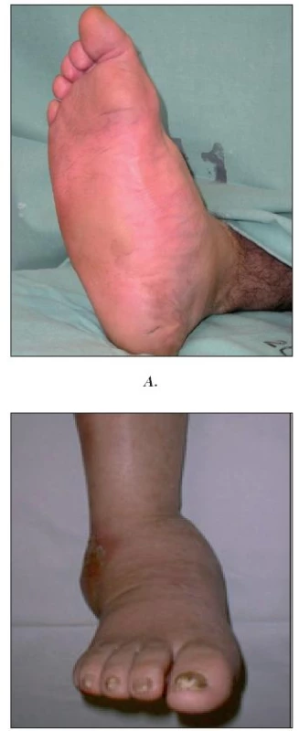 Charcotova osteoarthropatie
A. Aktivní stádium
B. Pokročilé stadium s postižením talokrurálního kloubu