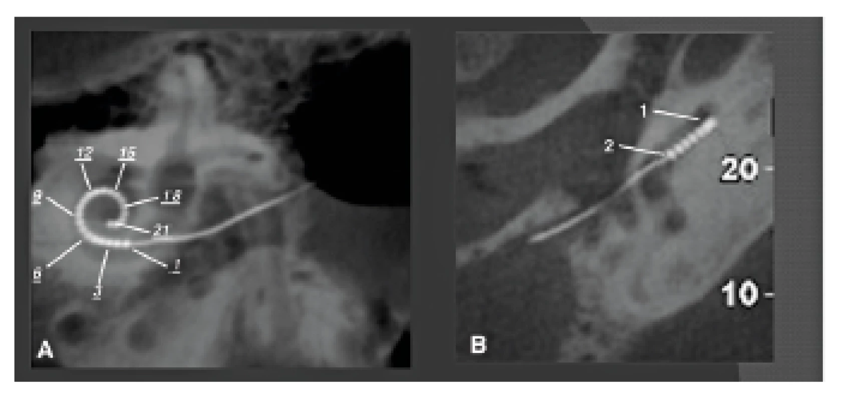 CBCT použité pro ověření polohy kochleárního implantátu (Cochlear Nucleus Freedom s kontaktními body v 22kanálové elektrodě).