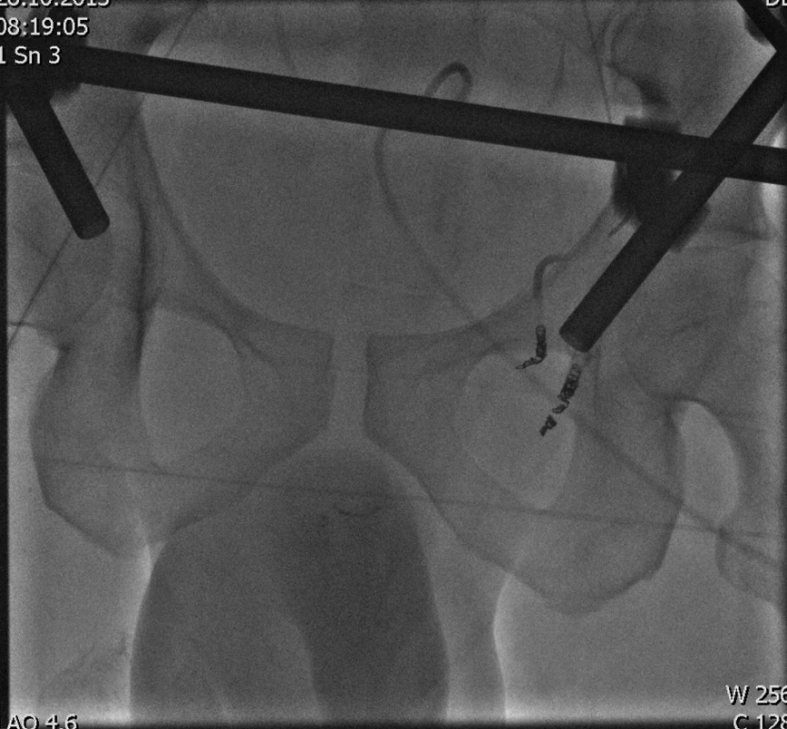 Polytraumatizovaný pacient po havárii na motocyklu ISS 26, hemoragický šok, provedena damage control orthopaedics naložením ZF na zlomeninu pánve C3 s retroperitoneálním hematomem, provedena epicystostomie pro poranění močové trubice a z operačního sálu byl pacient odvezen na angiolinku, kde byla provedena embolizace krvácející větve vnitřní pánevní tepny. Druhý den provedena embolizace další krvácející větve vnitřní pánevní tepny.
Fig. 2: Polytraumatized patient involved in a motorcycle accident ISS 26, haemorrhagic shock ,Damage Control Orthopaedics procedure was performed, external fixator was applied to the pelvic fracture type C3, with retroperitoneal haematoma, epicystostomy was performed due to urethral trauma; the patient was transferred to the catheterization lab from the operating theatre for embolization of a bleeding branch of the internal iliac artery. Another embolization of a different bleeding branch of the internal iliac artery was performed on the next day.
