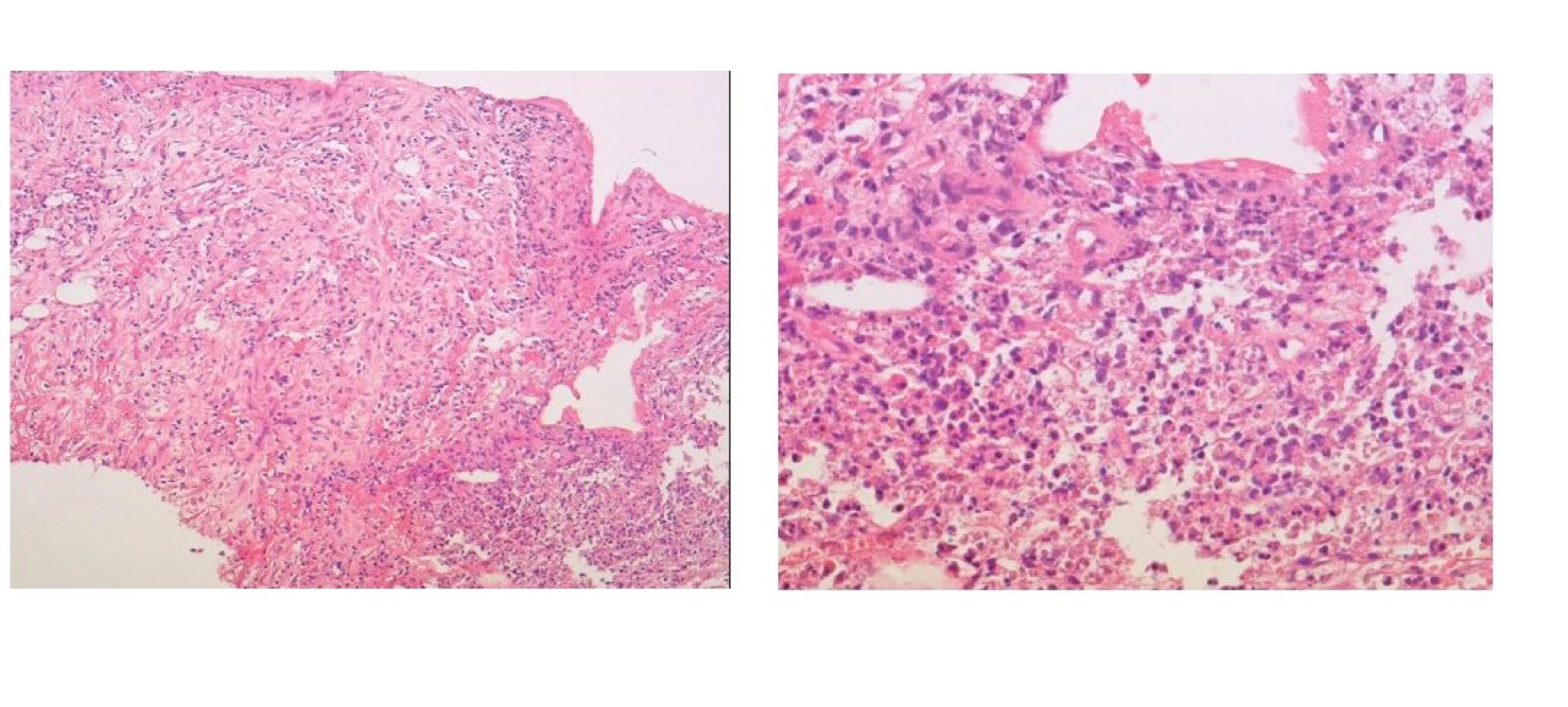 a) Mikroskopický obraz punkční biopsie ložiska jater s úsekem vaziva a v okraji s nekrózou a zánětem. Barvení HE, zvětšení objektiv 10x.
b) Mikroskopický obraz punkční biopsie ložiska jater – detail zánětlivé celulizace z obrázku 3a. Barvení HE, zvětšení objektiv 40x.