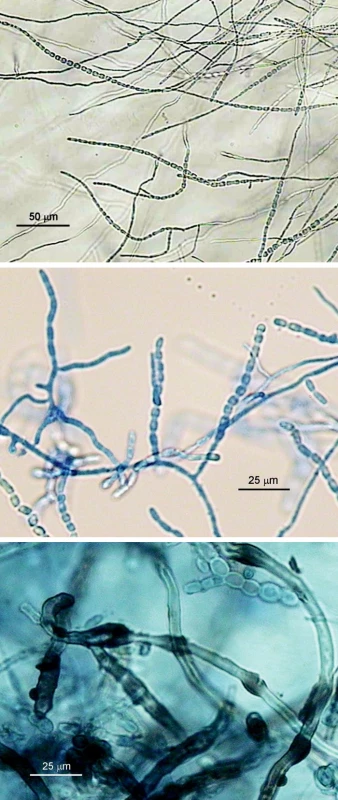 a, b, c. Onychocola canadensis, mikroskopická morfológia; a) hýfy a dlhé retiazky súdkovitých artrokonídií (mikrokultúra, vodný agar, 10 dní, 25 °C), b) dtto, 2-3-týždňová kultúra, preparát v laktofenole s metylovou modrou, c) retiazky 1- a 2-bunkových artrokonídií a hnedé „nodózne“ hýfy (preparát v laktofenole zo starej kultúry na SAB agare) (foto A.V.)
Fig. 4 a, b, c. Onychocola canadensis, micromorphology; a) hyphae and long chains of barrel-shaped arthroconidia (microculture, aqueous agar, 10 days, 25 °C), b) see a), 2-3-week culture, methylene blue-lactophenol mount, c) chains of single- and double-cell arthroconidia and brown nodular hyphae (lactophenol mount from previous Sabouraud agar culture) (photo A.V.)