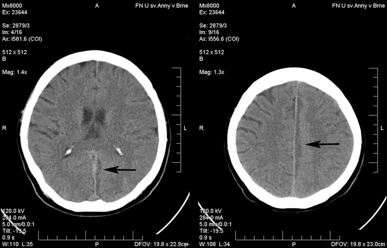 Nález interhemisferického subdurálního hematomu na CT vyšetření (označeno šipkou). Klinický rozvoj monoparézy dolní končetiny
Fig. 2. CT finding of interhemispheric subdural haematoma on CT (marked with arrow). Clinical picture of lower limb monoparesis