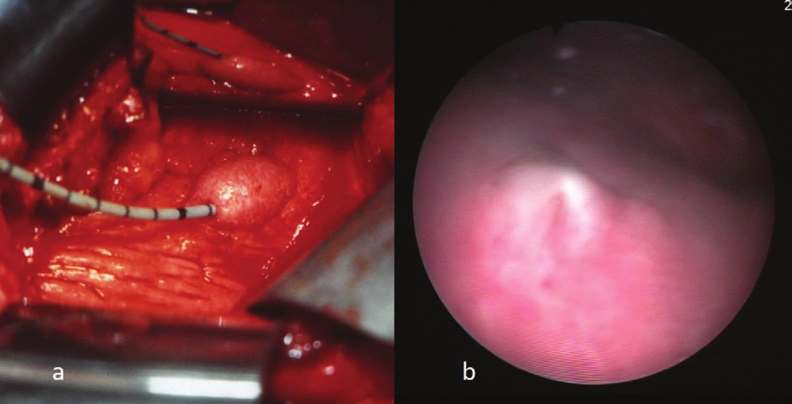 FT ureteroileální anastomóza do ortotopické neoveziky: a) 13. měsíc po implantaci,
b) cystoskopický pohled 68. měsíc po operaci.
Fig. 6: FT UIA into the ileal neobladder: a) 13 months, and 68 months, b) after the procedure