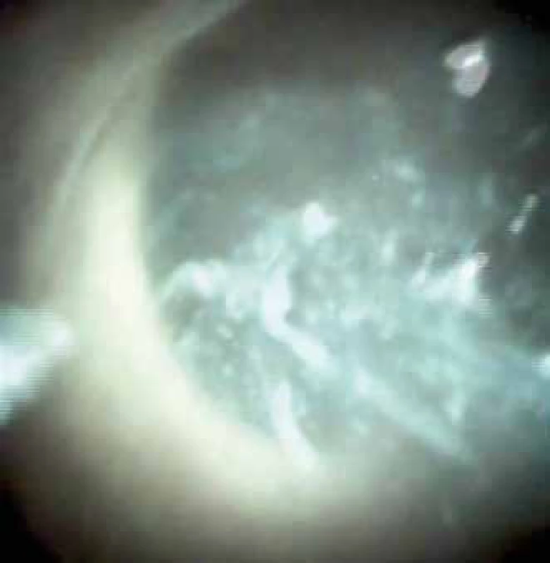 Pankreatoskopie. Mucin v dilatovaném pankreatickém vývodu, intraduktální papilární mucinózní neoplazie.
Fig. 10. Pancreatoscopy. Mucin in dilated pancreatic duct, intraductal papillary mucinous neoplasia.