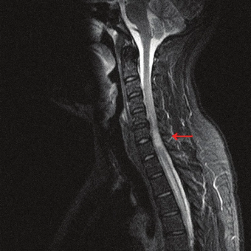 MRI krčnej miechy (STIR, sagitálny rez) s rozsiahlym intramedulárnym hyperintenzívnym ložiskom.