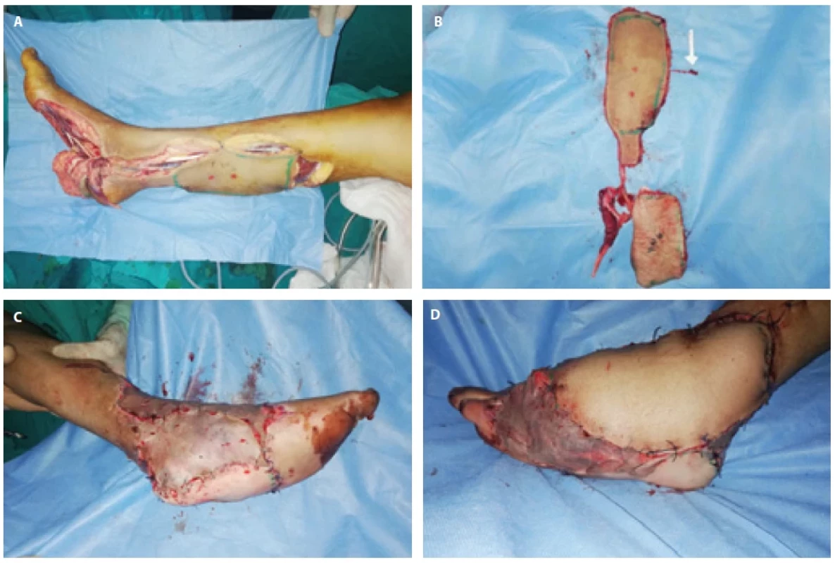 A) fl ap design and harvest, B) fl ap components with white arrows pointing to neurovascular pedicle, C, D) immediate post-operative.