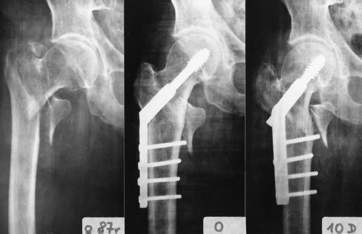 Medializace diafýzy femuru u nestabilní pertrochanterické zlomeniny: a – nestabilní pertrochanterická zlomenina, patrné výrazné oslabení laterální trochanterické stěny; b – pooperační snímek po osteosyntéze DHS 135°, mediální kortikalis obou hlavních fragmentů jsou v kontaktu; c – snímek 10 dní po operaci, jasně patrná medializace diafýzy femuru a ztráta kontaktu mediálních kortikalis, zlomenina laterální trochanterické stěny.
Fig. 17: Medial displacement of femoral shaft in an unstable pertrochanteric fracture: a – an unstable pertrochanteric fracture, an evident marked weakening of the lateral trochanteric wall; b – postoperative radiograph after internal fixation with DHS 135°, medial cortices of both main fragments are in contact; c – a radiograph 10 days postoperatively, an evident medial displacement of the femoral shaft and loss of contact of medial cortices, fracture of the lateral trochanteric wall.