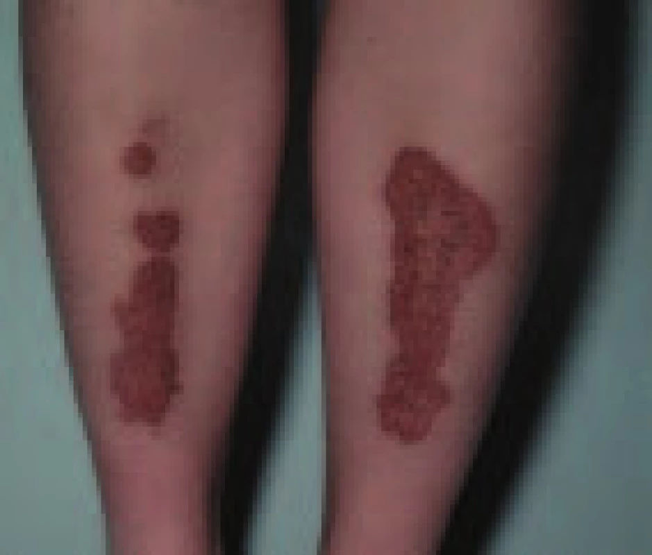 Necrobiosis lipoidica.