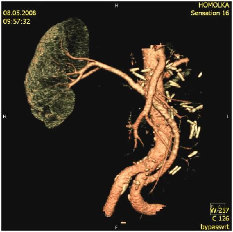 Kontrolní CT-AG iliakorenální rekonstrukce
Fig. 5. Control CT-AG iliaco renal reconstruction
