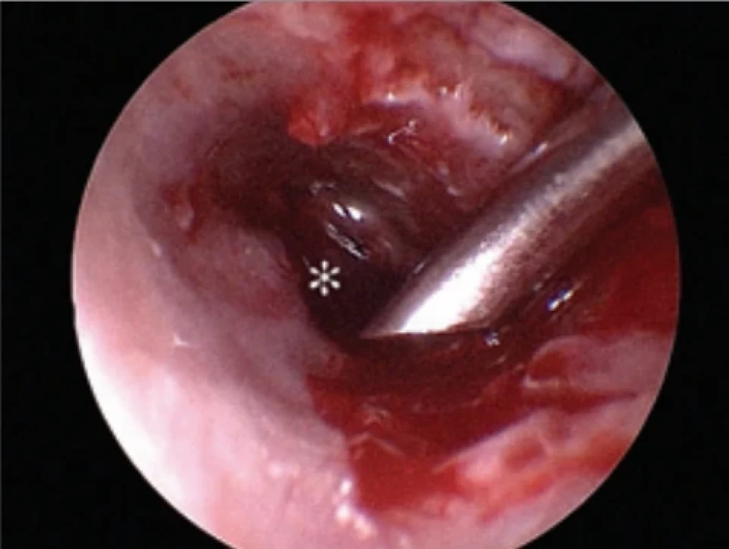  Endoskopický pohled do středouší ukazuje odsávání perilymfy (*). Fig. 3. Endoscopic view of the middle ear showing aspiration of the perilymph (*).