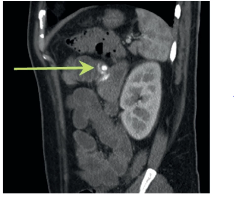 Sagitální řez CT-AG
Šipka označuje intraluminální zdroj krvácení v orálním jejunu.
Fig. 2: Sagittal section of CT-AG
The arrow marks the cause of bleeding intraluminally in oral jejunum.