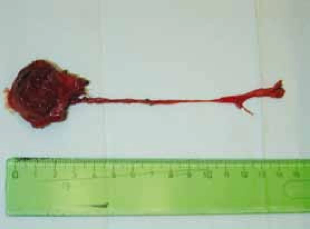 Excidovaný tumor s urachem – preparát
Fig. 4. Excised tumor with urachus – specimen