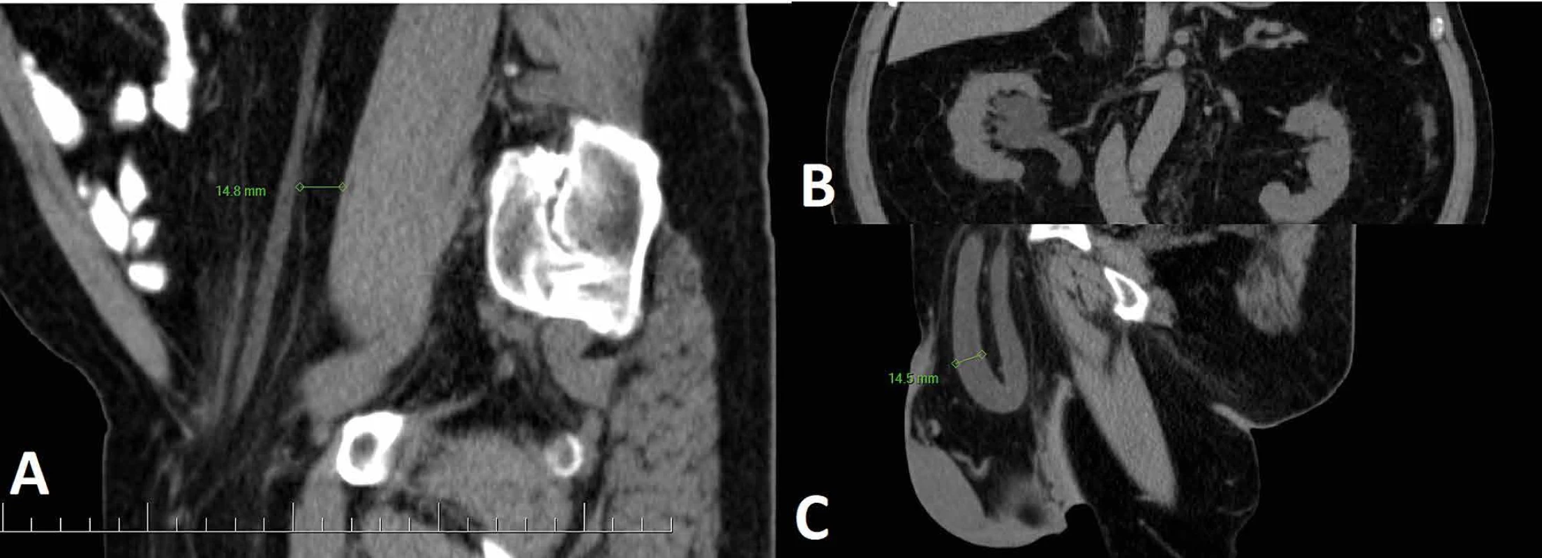 CT nález </br>  Fig. 1: CT finding