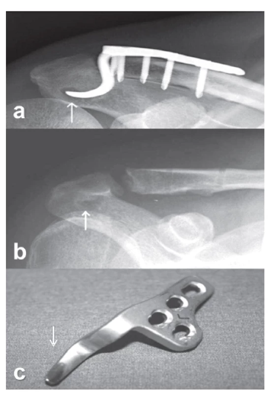 Osteolýza akromia kolem háku dlahy: a – mírná osteolýza 3 měsíce od operace, b – změna spodního reliéfu akromia po extrakci dlahy, c – korespondující ohlazení háku dlahy (šipky).
Fig. 2: Osteolysis of acromion around the plate hook: a – mild osteolysis 3 months after the surgery, 
b – change in the inferior contour of the acromion after plate extraction, c – corresponding abrasion of the plate hook (arrows).