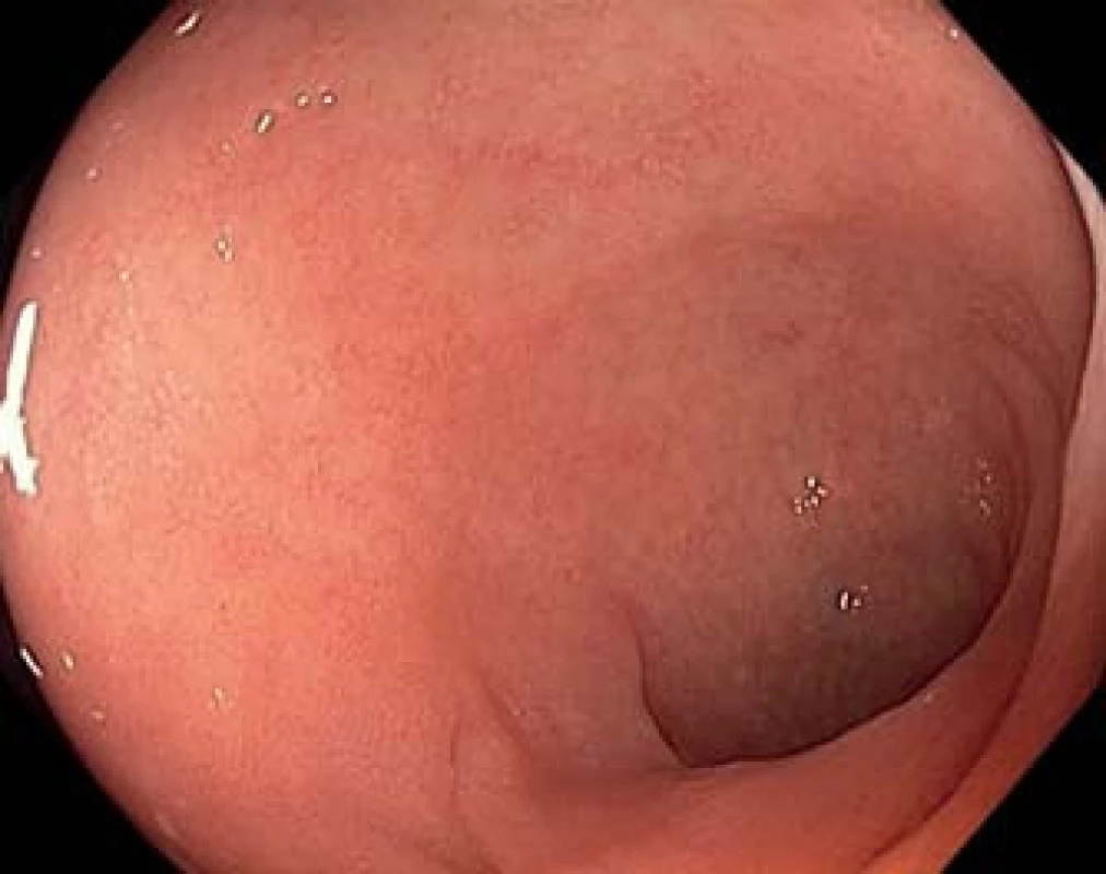 Koloskopie (Olympus CF H180AL). Terminální ileum s obrazem zkrácených klků.
Fig. 1. Colonoscopy (Olympus CF H180AL). Terminal ileum with shortened villi.