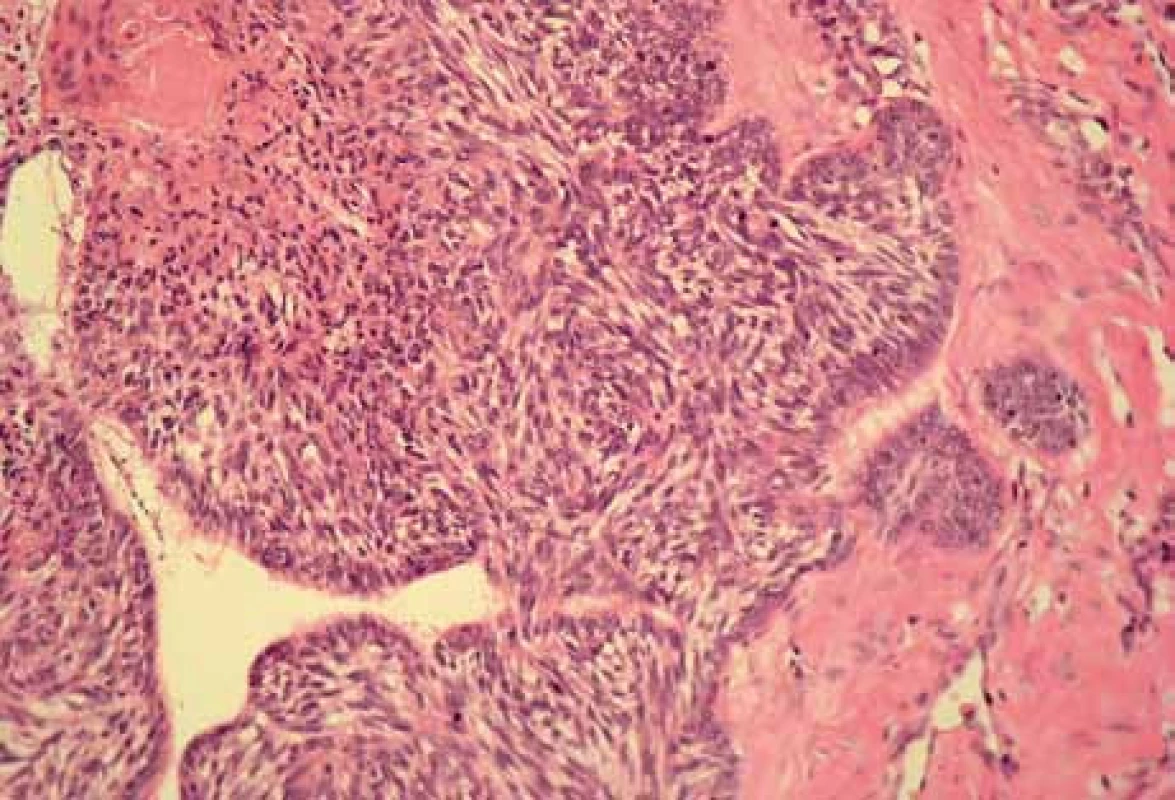 Histomorphological picture of metatypical carcinoma (hematoxylin and eosin staining, magnification 120×).