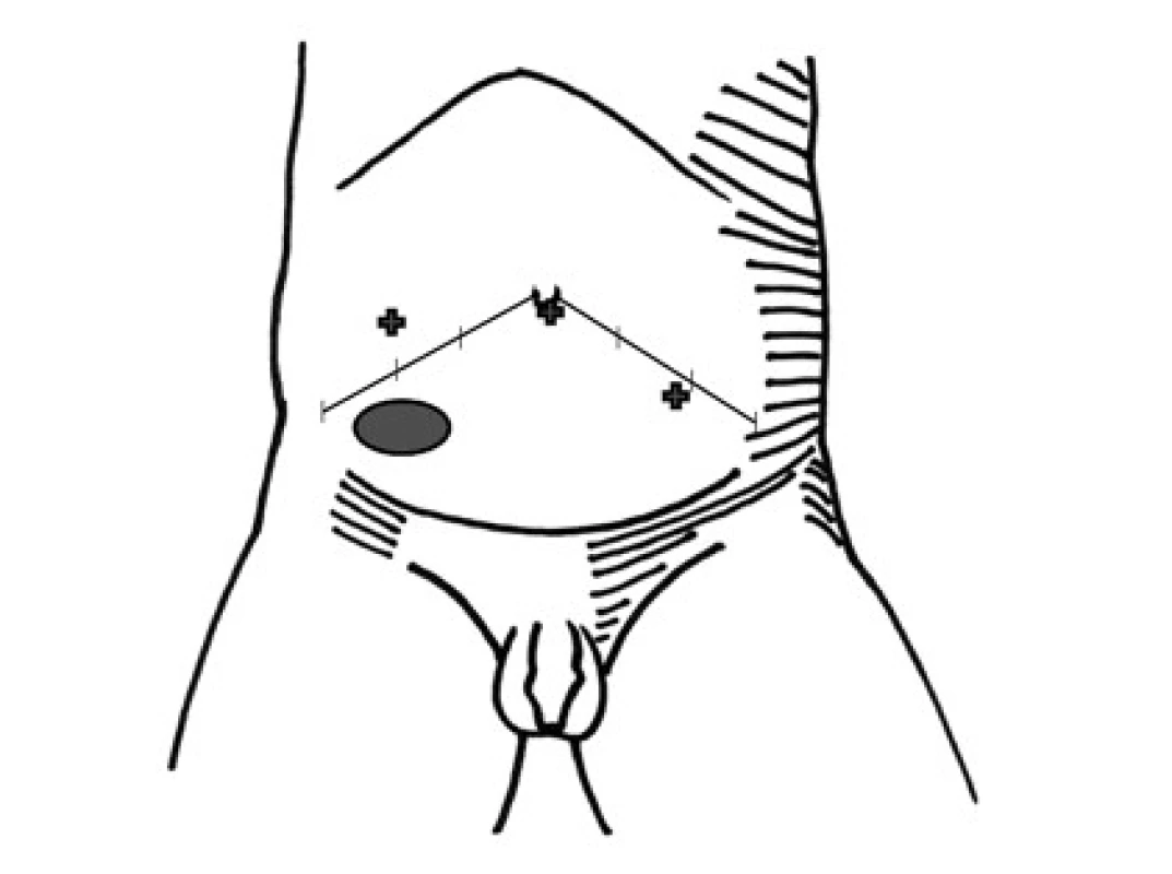 Poloha optiky a pracovních portů (křížky) při laparoskopii pro nehmatné varle
Fig. 1. Position of camera and working ports (crosses) at laparoscopy for impalpable testis