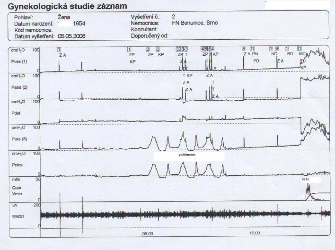 Záznam UD vyšetření pravého močového měchýře.