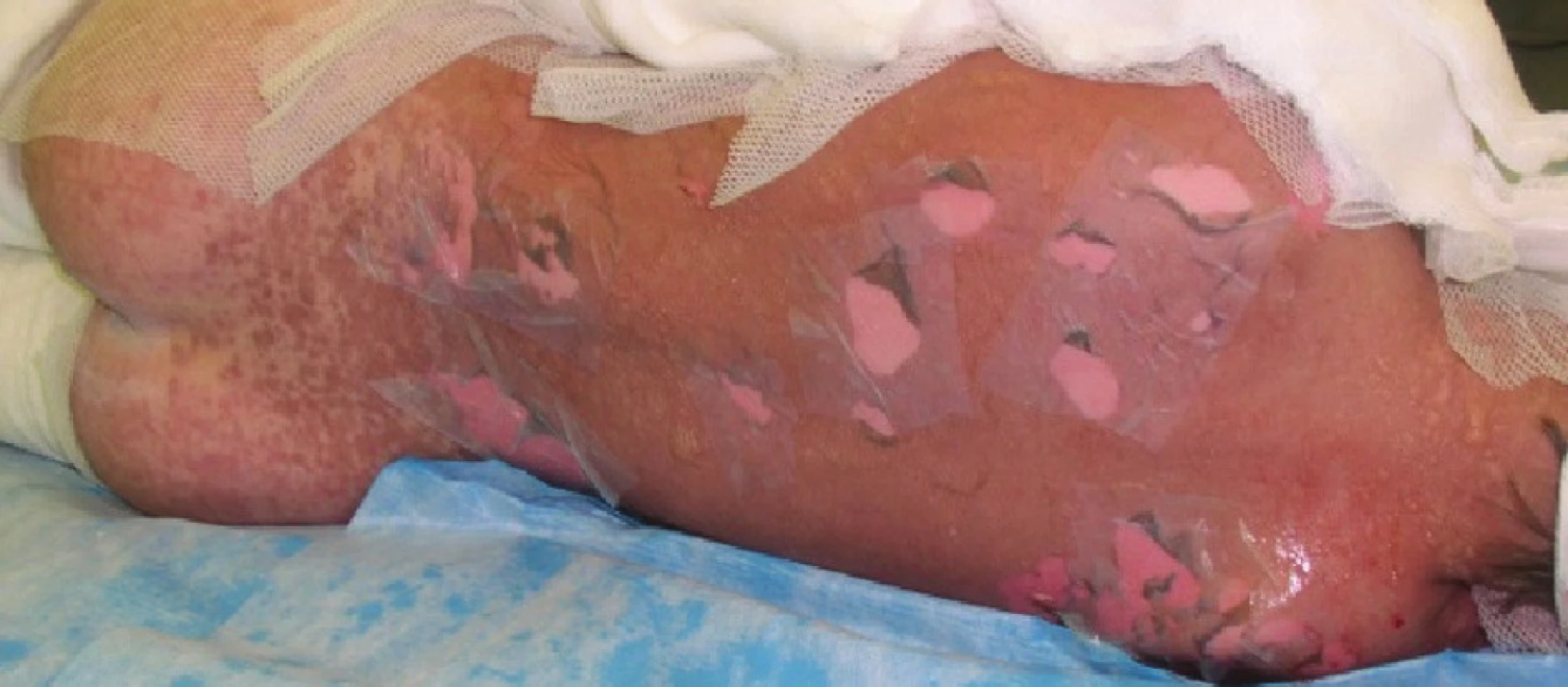 Exfoliované plochy na zádech kryté Xe-Dermou
Fig. 2: Exfoliated areas on the back covered with Xe-Derma