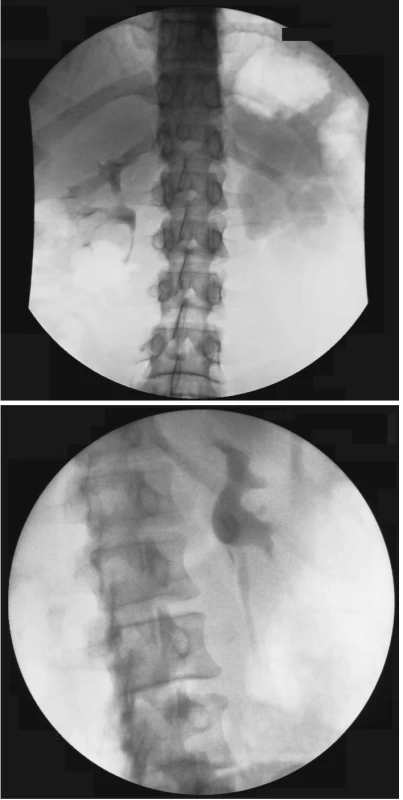 a, b. Výsledek neresekční Fengerovy pyeloplastiky
Fig. 3 a, b. Outcomes of the non-resection Fenger pyeloplasty