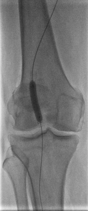 Dodilatácia implantovaného stentu
Fig. 2. Final dilation of the implanted stent