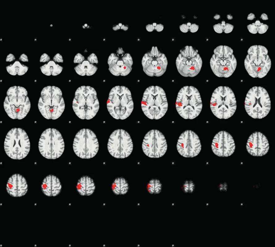 Průměrné skupinové aktivace na fMRI mozku při pohybu levým zápěstím, 6 měsíců po operaci krční páteře (Po terapii došlo vizuálně k významnému zmenšení rozsahu aktivací i maximálního Z-skóre ve většině oblastí.)
Fig. 2: Analysis of mean group effects in brain fMRI during movement of left wrists, six months after surgery. After surgical therapy, the cortical activations and maximum Z-scores decreased in most areas. (Background − T1-weighted scans with high resolution (sequences >MPRAGE). Picture - statistical Z-maps -red (minimum), yellow (maximum).
