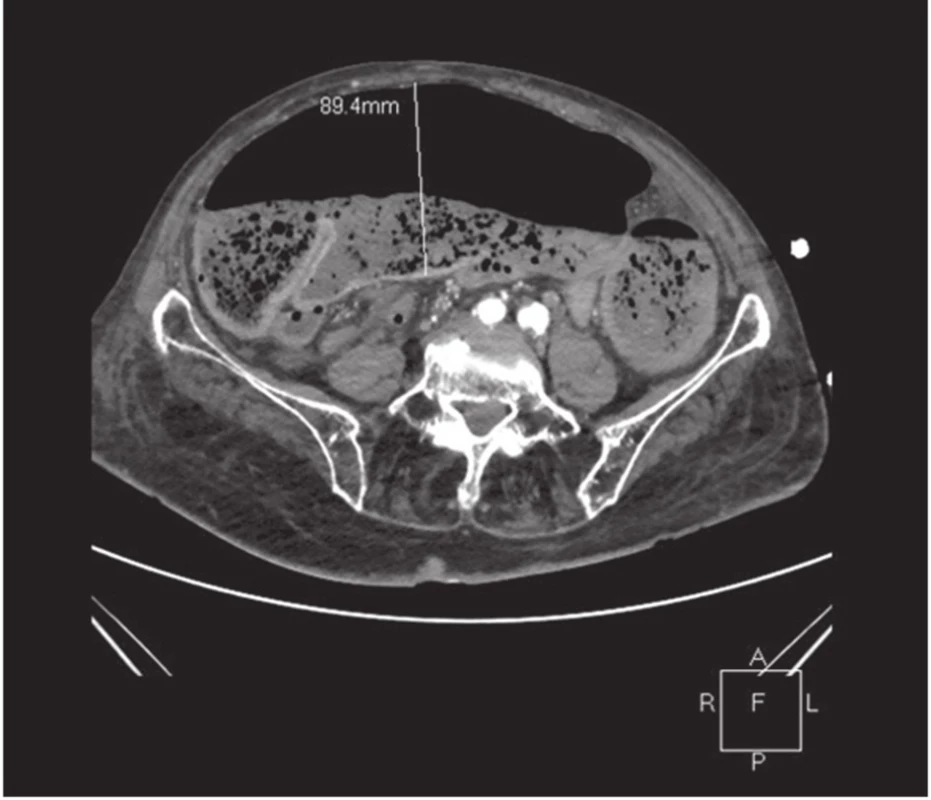 CT obraz ileu dilatovaný tračník s maximem až 9 cm,
Fig. 1: CT image of the ileus, colon dilated to a maximum of up to 9 cm