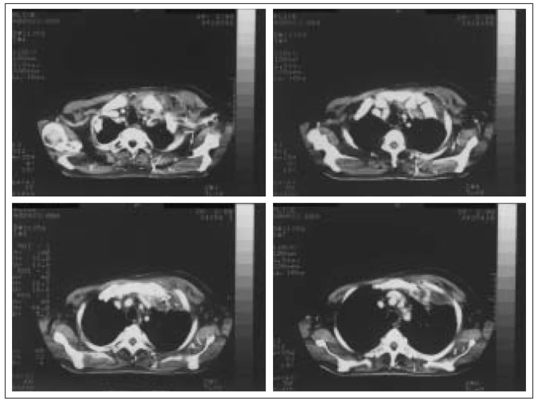 Abscedující pneumonie v horním laloku levé plíce a měkkých tkání hrudní stěny v.s. metastatického původu u pacienta s 20letou anamnézou DM v.s. sekundárního léčeného inzulinem.