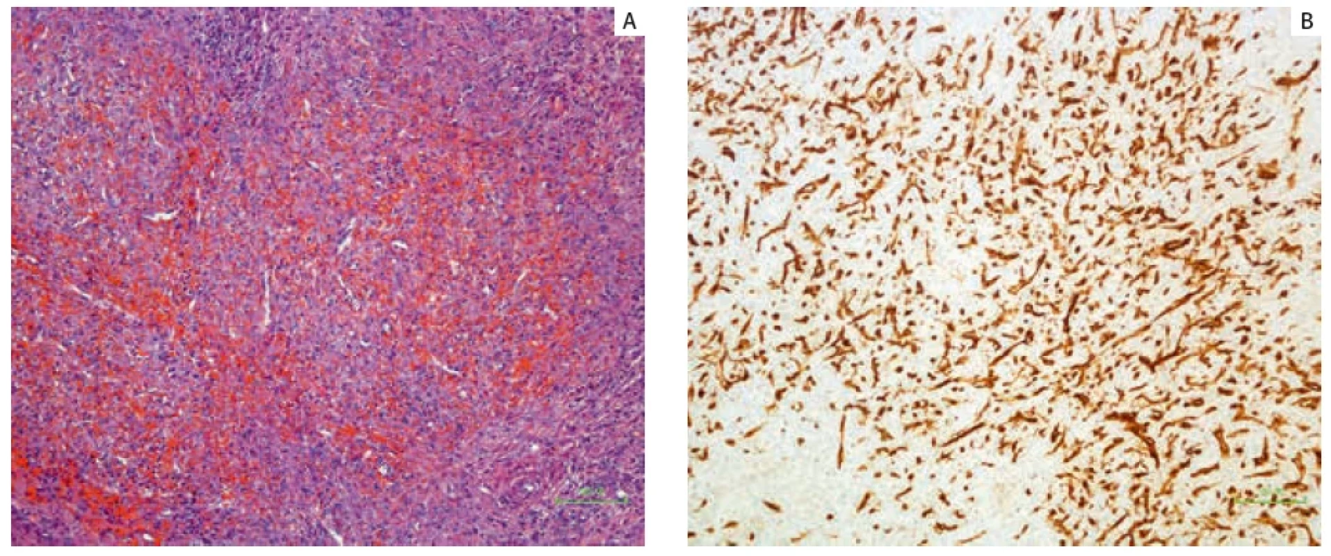 Hematoxylin and eosin staining revealed multiple angiomatoid nodules separated by fibrous or fibrosclerotic stroma (H&E staining, ×100). B. CD34+ capillaries and small veins (immunohistochemical staining ×40). Barvení hematoxylinem a eosinem odhalilo mnohočetné angiomatoidní uzliny oddělené fibrózním nebo fibrosklerotickým stromatem (barvení H&E, 100×). B. CD34+ kapiláry a malé žíly (imunohistochemické barvení 40×).
