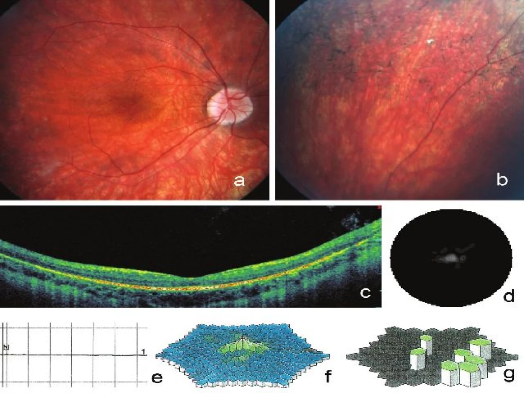 Klinické nálezy zjištěné na pravém oku u 22letého muže (IV:5) s retinitis pigmentosa podmíněnou mutací v ORF15 genu <i>RPGR</i>. Na fotografii fundu je patrné prořídnutí retinálního pigmentového epitelu, zúžené arterie, bledý terč zrakového nervu a) a větší množství shluků pigmentu tvaru kostních buněk b), vertikální SD-OCT makuly dokumentuje sníÏení tloušťky neuroretiny a tenkou cévnatku se zvýrazněním jejích struktur při úbytku RPE c). Koncentrické zúžení zorného pole d), vyhaslá tyčinková odpověď e), snížení hustoty odpovědí na trojrozměrném obraze při multifokální ERG f), zbytkové oblasti elektrické aktivity sítnice představované zelenými šestiúhelníky g)