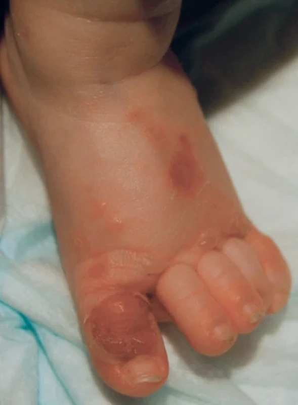 Acrodermatitis enteropathica