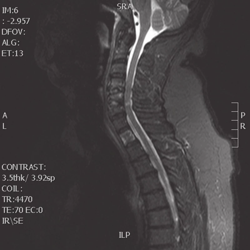 MRI krční páteře, sagitální, T2-vážený sken (Žena, 56 let, 3 měsíce po přední operaci C4−6, rozšíření předozadního rozměru páteřního kanálu na 9,2 mm, myelopatické změny míchy).
Fig. 4: MRI of cervical spine, T2-weighted sagital scan (Female patient, 56-year-old, three months after surgery at levels C4−6, enlargement of the anteroposterior cervical spinal canal distance to 9.2 mm, myelopathic changes)