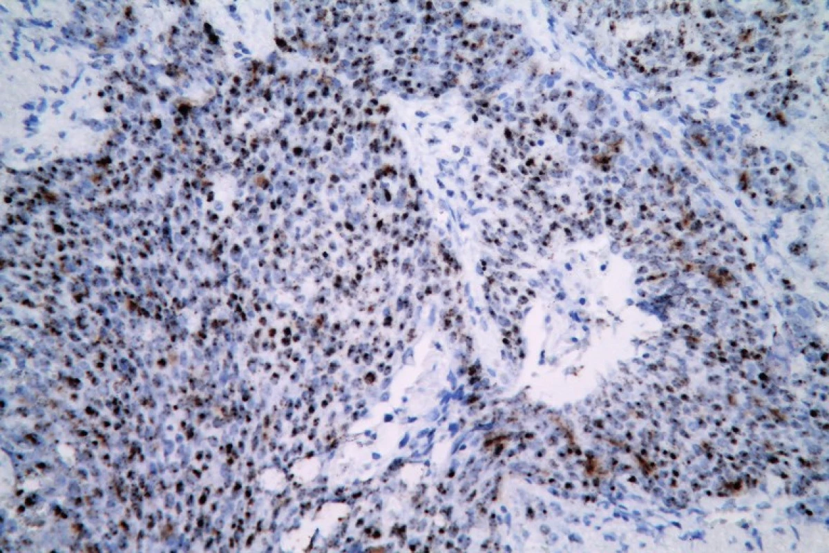 Pozitívny výsledok RNA in situ hybridizácie v nekeratinizujúcom SCC tonzily (HPV RNAscope ISH, zväčšenie x40).