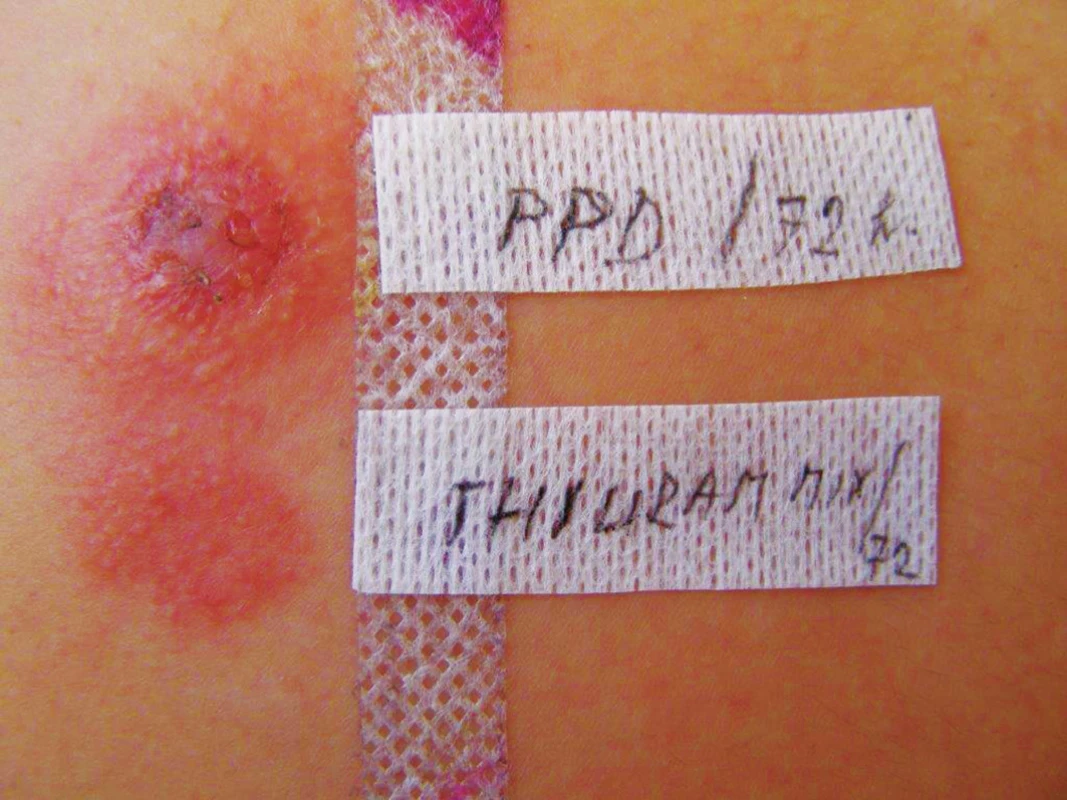 Silně pozitivní reakce v epikutánním testu na parafenylendiamin a thiuram mix