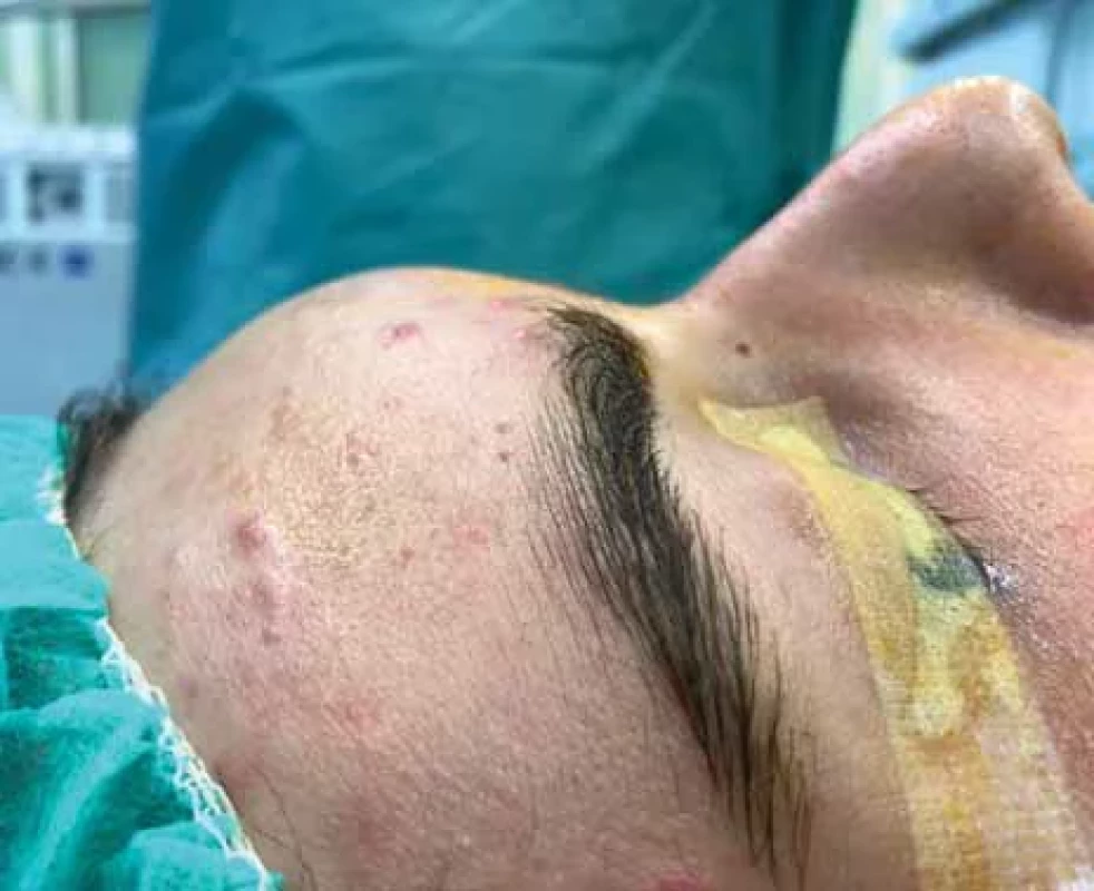 Klinický nález předoperačně, fl uktuující zduření frontální krajiny.